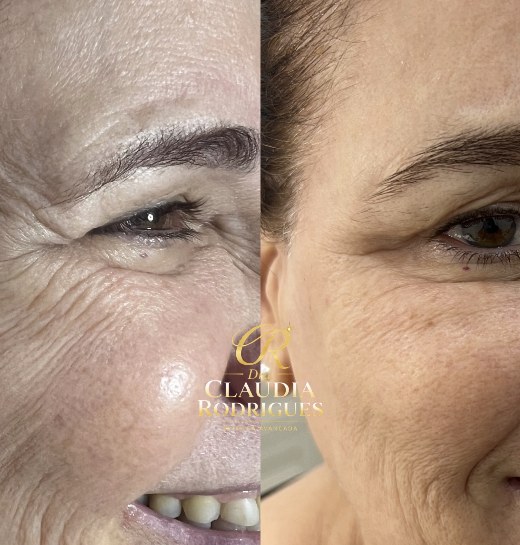 Região dos olhos antes e depois do tratamento